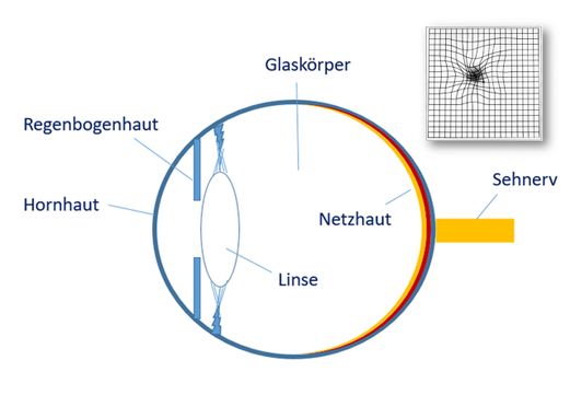 Netzhaut-OP