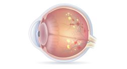 Diabetes Auge