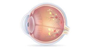 Makulopathie/Retinopathie